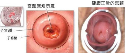 运城宫颈糜烂的症状有哪些